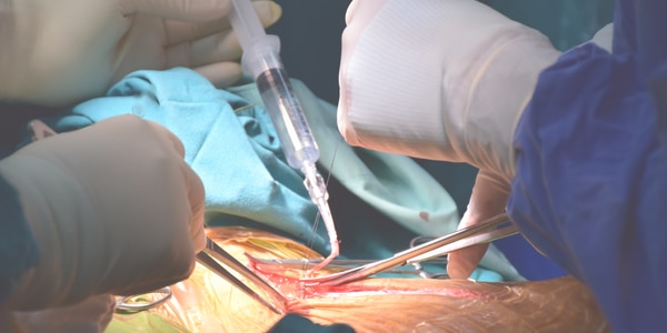 Principes van chirurgische revascularisatie voor operatieassistenten