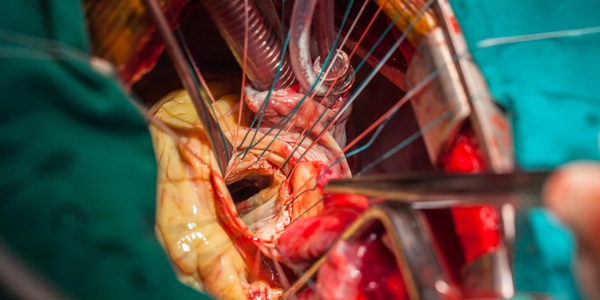 Principes van cardio-thoracale chirurgie voor operatieassistenten